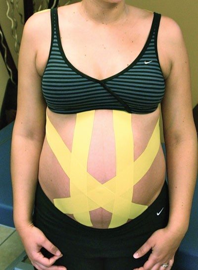 picture of a woman with Kinesiology tape for pregnancy discomfort