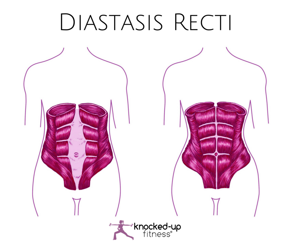picture of diastasis recti